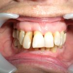 Terrain parodontal affaibli, besoin de solidariser les dents pour assurer leur pérennité dasn le temps