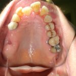 Séquelles de maladie parodontale