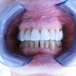Fin de traitement orthodontique sur terrain parodontal affaibli