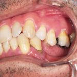 Préparation avant prothèse