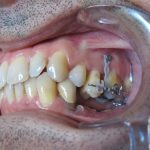 Mise en place de minivis pour réingresser les dents supérieures