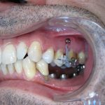 Après ingression des dents supérieures, les implants mandibulaires sont posés