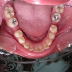 Photo arcade inférieure avant traitement, perte/extraction des 1ères molaires inférieures