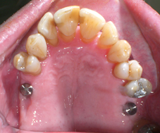 Atelle coulée colée avant traitement orthodontique