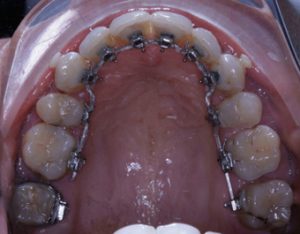 Appareil multiattache (bagues) en lingual