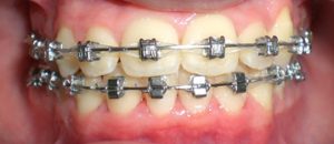 Appareil multiattache (bagues) en vestibulaire