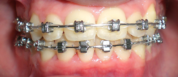 Appareil multiattache (bagues) en vestibulaire