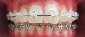 Appareil multiattache (bagues) en vestibulaire