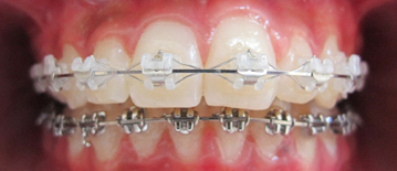 Appareil multiattache (bagues) en vestibulaire