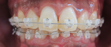 Appareil multiattache (bagues) en vestibulaire