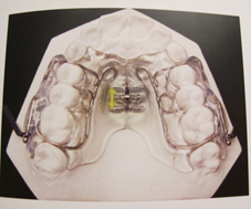 Appareil propulsion mandibulaire PUL