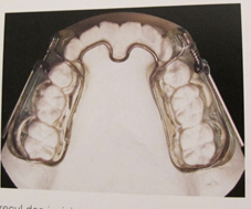 Appareil propulsion mandibulaire PUL