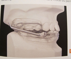 Appareil propulsion mandibulaire PUL