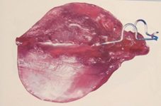 Appareil propulsion mandibulaire l'activateur