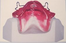 Appareil propulsion mandibulaire l'activateur