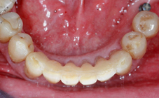 Attelle fibrée après traitement orthodontique