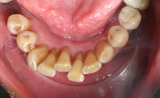 Attelle fibrée avant traitement orthodontique