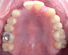 Bridge cantilever après traitement orthodontique