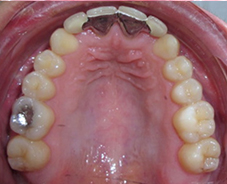 Bridge collé en cantilever, piliers de bridge 11-21