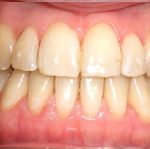 Cas clinique intra-buccale de face après traitement