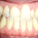 Cas clinique intra-buccale de face avant traitement