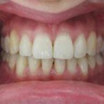 Photo intra-buccale de face après traitement