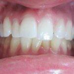 Photo intra-bucale de face avant traitement