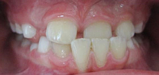 Multi-attache partiel