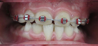 Multi-attache partiel