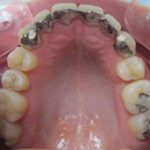 Arcade supérieure avec attelle de contention coulée collée