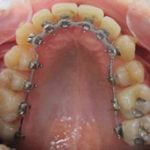 Arcade supérieure pendant le traitement