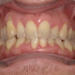 Traitement par gouttière Spark - Cas n°1 - Intra orale face : début de traitement