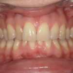 Traitement par gouttière Spark - Cas n°2 - Intra orale face : début de traitement