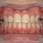 Motion Carriere® avec gouttière thermoformée maxillaire et élastiques