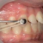 Motion Carriere® avec gouttière thermoformée maxillaire et élastiques