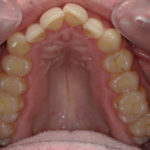 Traitement par gouttière Spark - Cas n°1 - Intra orale supérieur : début de traitement