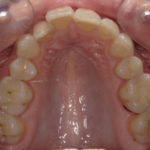 Traitement par gouttière Spark - Cas n°2 - Intra orale supérieur : début de traitement