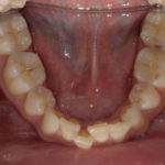 Traitement par gouttière Spark - Cas n°2 - Intra orale inférieur : début de traitement