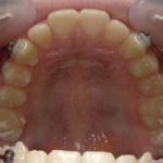 Motion Carriere® avec gouttière thermoformée maxillaire et élastiques