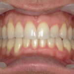 Traitement par gouttière Spark - Cas n°1 - Intra orale face : traitement intermédiaire