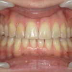 Traitement par gouttière Spark - Cas n°2 - Intra orale face : traitement intermédiaire