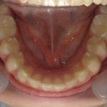 Motion Carriere® avec gouttière thermoformée maxillaire et élastiques