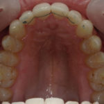 Traitement par gouttière Spark - Cas n°1 - Intra orale supérieur : traitement intermédiaire