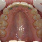 Traitement par gouttière Spark - Cas n°2 - Intra orale supérieur : traitement intermédiaire