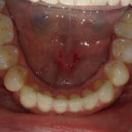 Traitement par gouttière Spark - Cas n°1 - Intra orale inférieur : traitement intermédiaire