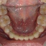 Traitement par gouttière Spark - Cas n°2 - Intra orale inférieur : traitement intermédiaire